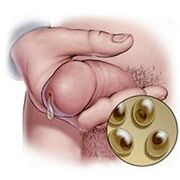 décharge de chlamydia